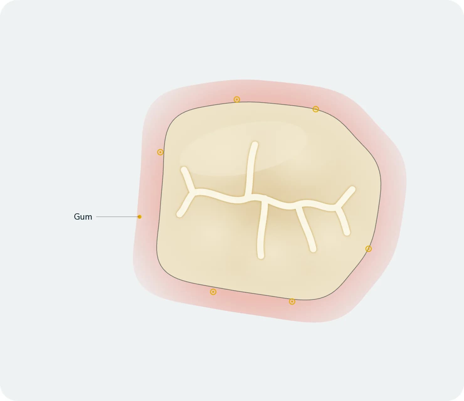 Illustration: Zahnfleischbehandlung, nach der Behandlung